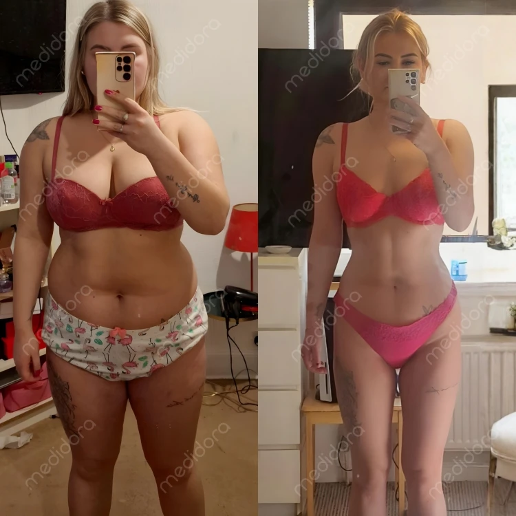 Magen-OP in der Türkei Vorher Nachher