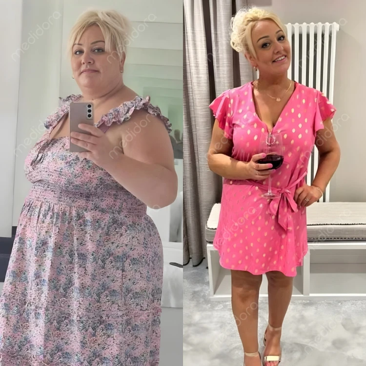 Magen-OP in der Türkei Vorher Nachher