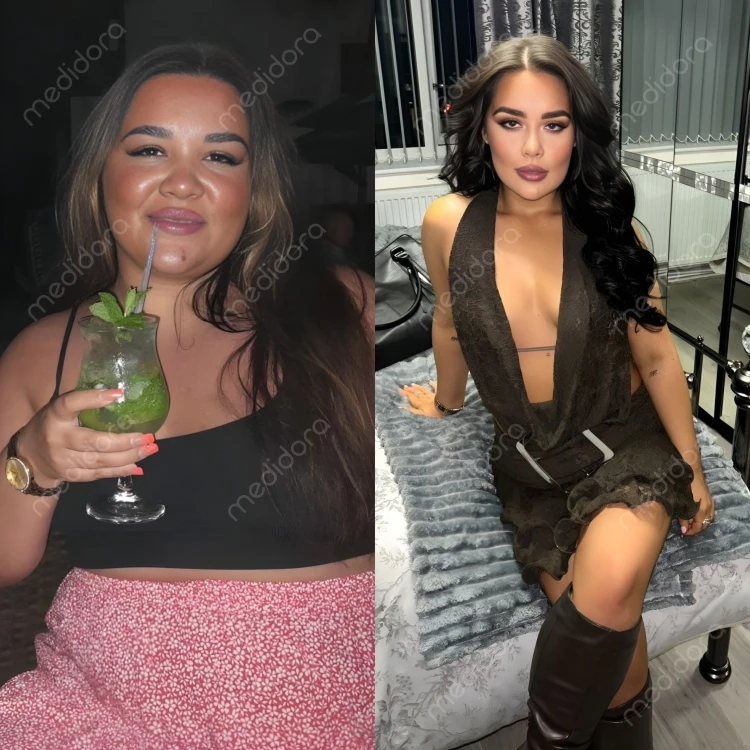 Magen-OP in der Türkei Vorher Nachher