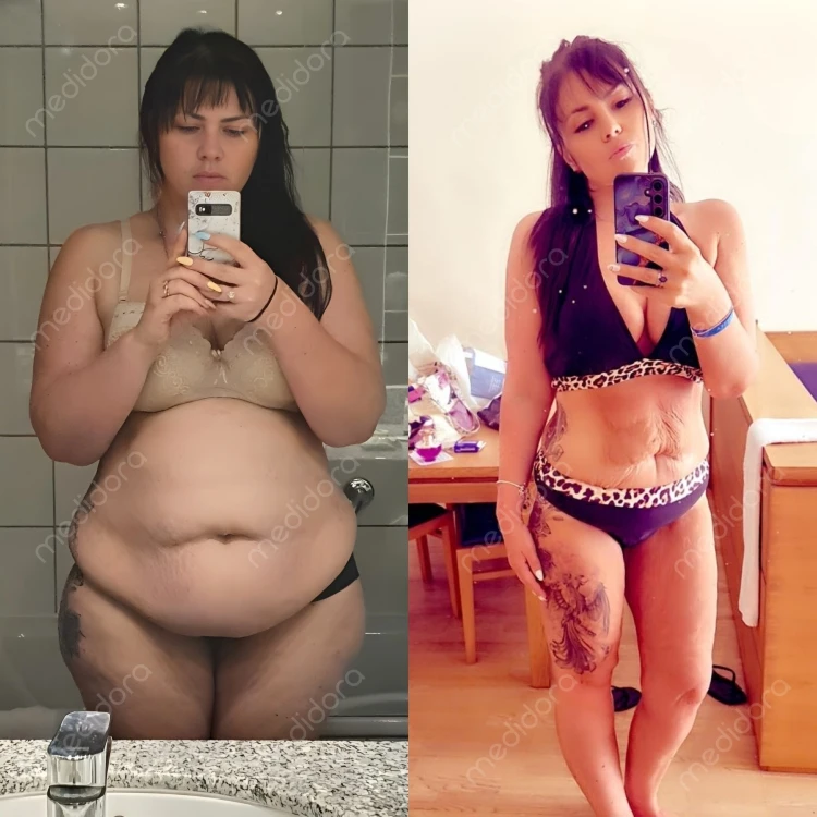 Magen-OP in der Türkei Vorher Nachher