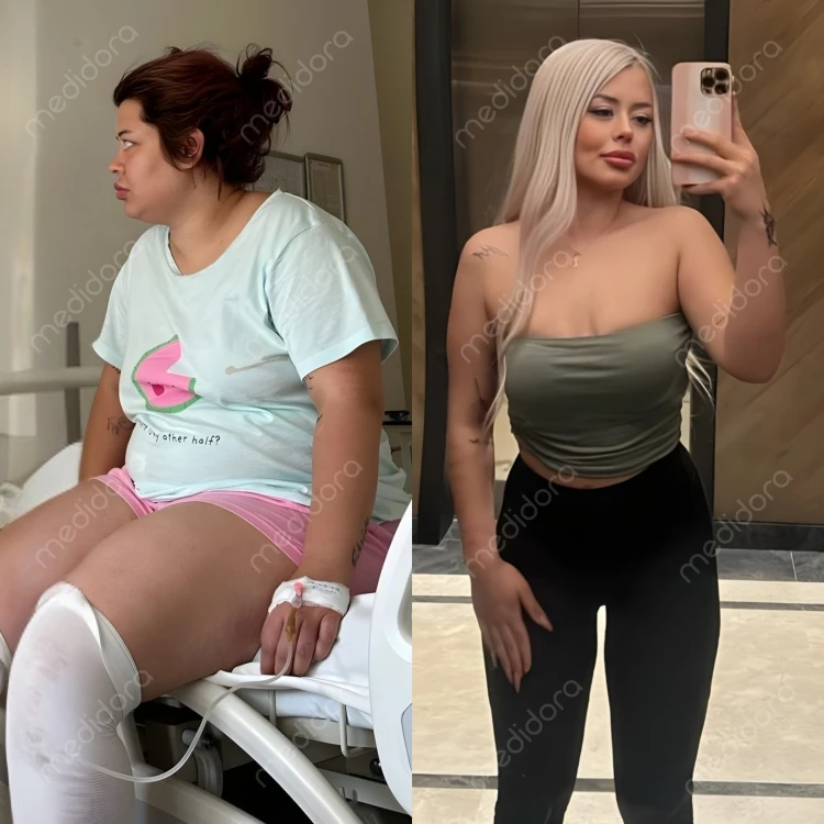 Magen-OP in der Türkei Vorher Nachher