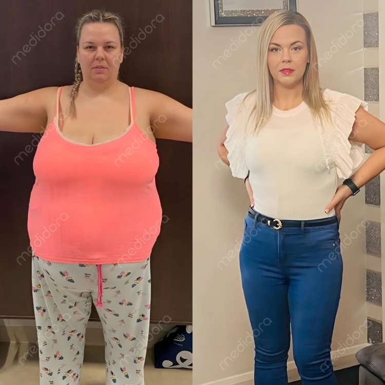 Magen-OP in der Türkei Vorher Nachher