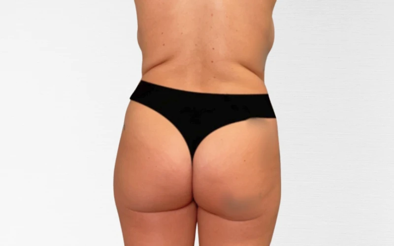 Vorher-Nachher Bilder Fettabsaugung