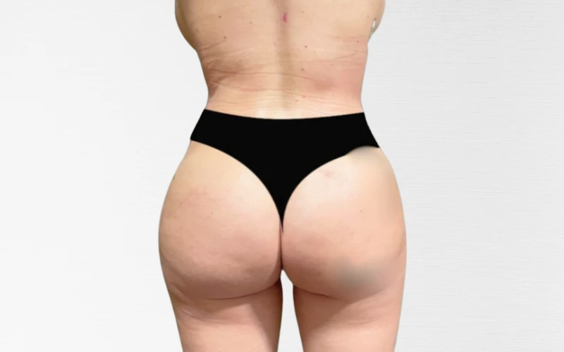 Vorher-Nachher Bilder Fettabsaugung